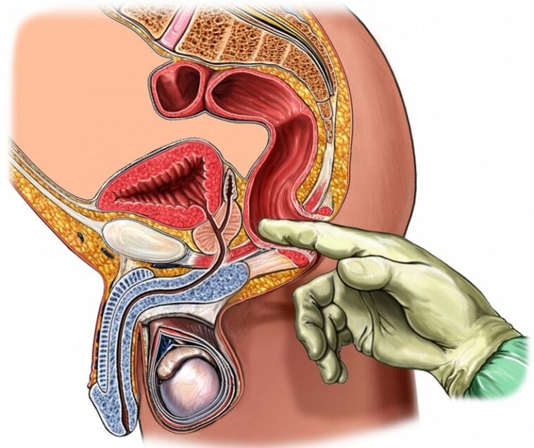 prostate massage for prostatitis